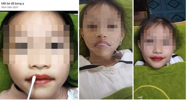 Bé gái 5 tuổi được đưa đi phun xăm môi​​​​​​​: Bác sĩ cảnh báo "Có thể gây hại cho trẻ"