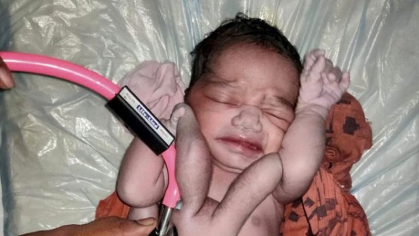 Kỳ lạ em bé sinh ra với 4 tay và 4 chân, được người dân ca tụng là "phép màu của tự nhiên"